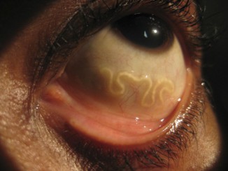 The Loa Loa is one of the most horrifying parasites on the planet.